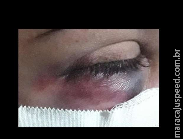 Namorado manda cotovelada na cara de mulher durante discussão no Coophavila II Namorado manda cotovelada na cara de mulher durante discussão no Coophavila II