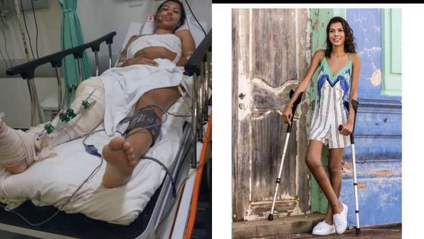 Nilda perderia a perna, não fosse a fé da mãe e doação de sangue de desconhecidos Nilda perderia a perna, não fosse a fé da mãe e doação de sangue de desconhecidos