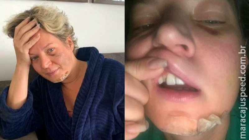 Após acordar ensanguentada e com fraturas, Joice Hasselmann aciona Depol Após acordar ensanguentada e com fraturas, Joice Hasselmann aciona Depol