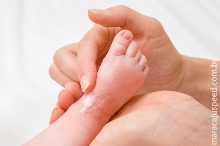 Protocolo para tratamento de doença que causa ressecamento da pele é aprovado no SUS