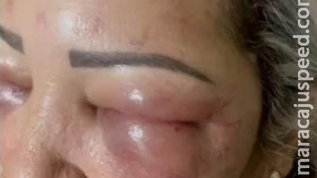 Mulher tem rosto desfigurado após procedimento estético na fronteira de MS