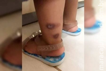 Avô que ficou com guarda de bebê queimada pelo padrasto: “Quero ela feliz e saudável” 