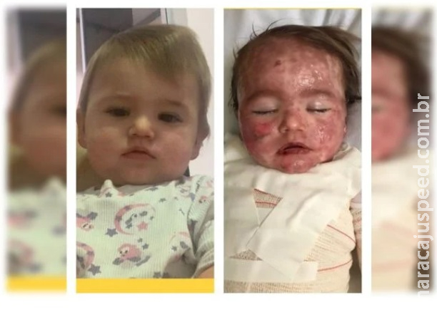 Bebê tem reação alérgica e acaba com rosto desfigurado