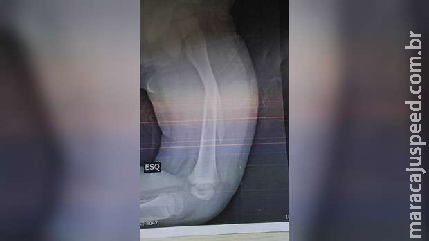 Criança cai em Emei, quebra o fêmur e mãe acende alerta: "não sei o que aconteceu"