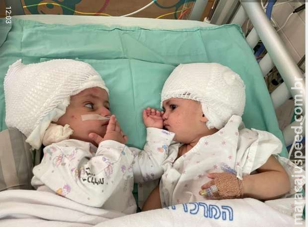 Gêmeas siamesas nascidas pela parte de trás da cabeça conseguem se ver após cirurgia