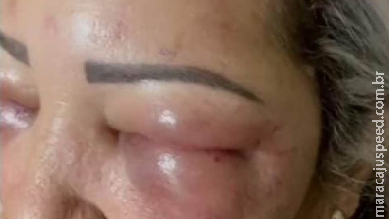 Mulher tem rosto desfigurado após procedimento estético na fronteira de MS