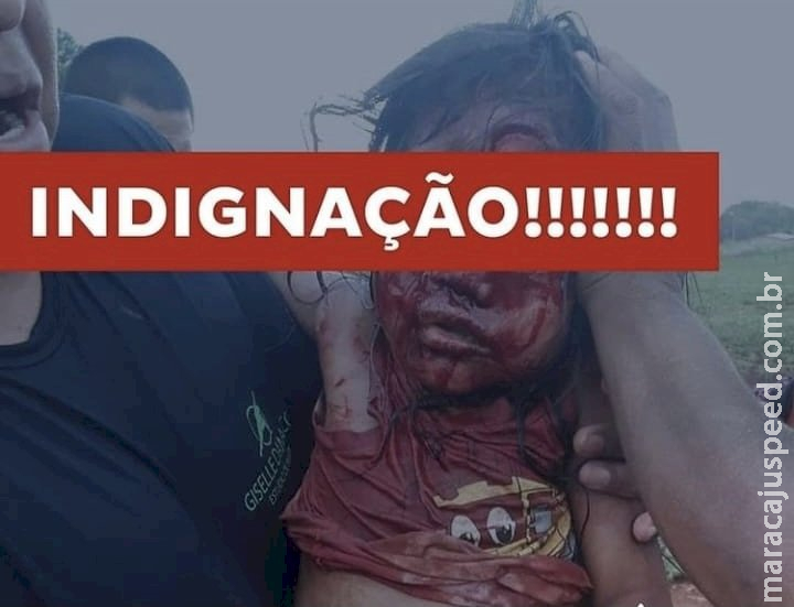 Criança fica em estado grave após ser atacada por cão Criança fica em estado grave após ser atacada por cão