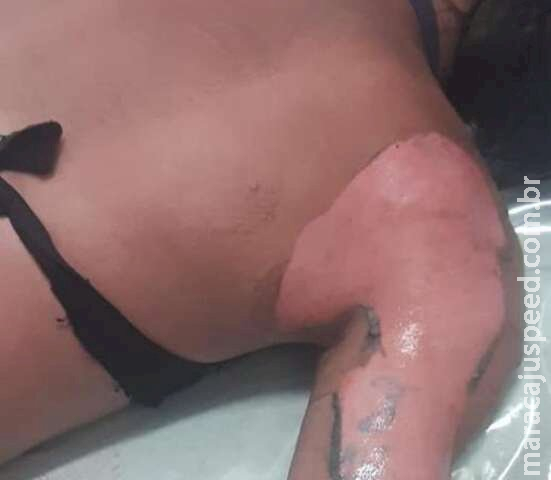 Preso que teve corpo queimado iniciou incêndio em presídio na fronteira Preso que teve corpo queimado iniciou incêndio em presídio na fronteira