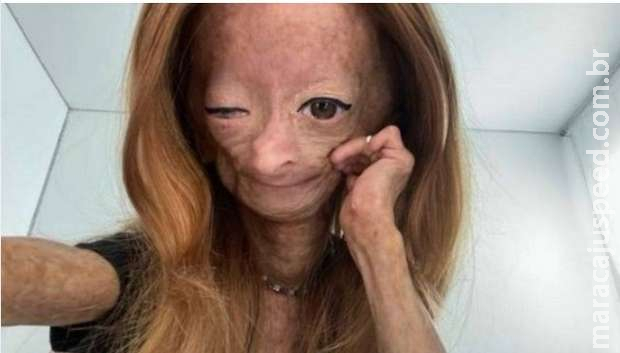 Adalia Rose, youtuber que sofria de doença de Adalia Rose, youtuber que sofria de doença de