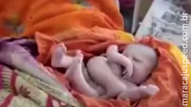 Bebê nasce com quatro braços e pernas e seria reencarnação de um deus na Índia Bebê nasce com quatro braços e pernas e seria reencarnação de um deus na Índia
