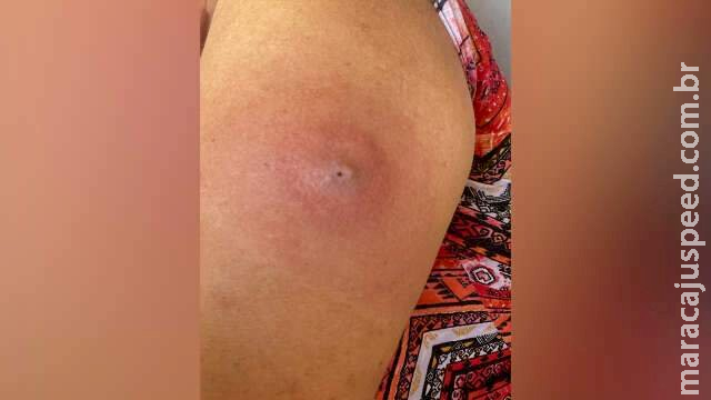 Seis meses após tomar segunda dose, mulher reclama de reação da vacina em MS Seis meses após tomar segunda dose, mulher reclama de reação da vacina em MS