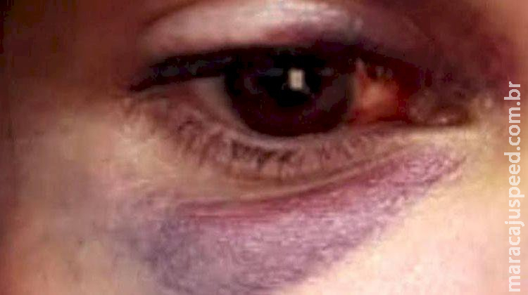 Com lesões após agressões do marido, mulher falta ao trabalho e mobiliza polícia em MS Com lesões após agressões do marido, mulher falta ao trabalho e mobiliza polícia em MS