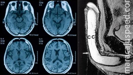 Covid afeta pênis, testículos e reduz tamanho do cérebro, dizem estudos Covid afeta pênis, testículos e reduz tamanho do cérebro, dizem estudos
