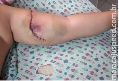 Criança tem braço rasgado em quadra de escola no Distrito Federal Criança tem braço rasgado em quadra de escola no Distrito Federal