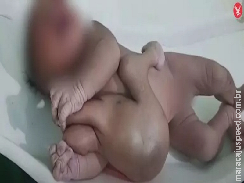 Bebê nasce com quatro braços e quatro pernas é tratado como divindade na Índia Bebê nasce com quatro braços e quatro pernas é tratado como divindade na Índia