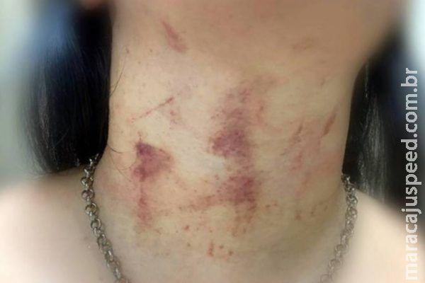 Mulher toma socos e mordidas após discutir com marido em Três Lagoas Mulher toma socos e mordidas após discutir com marido em Três Lagoas