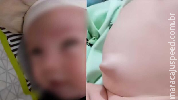 Com duas hérnias, bebê de 6 meses precisa de cirurgia e não consegue vaga em Campo Grande Com duas hérnias, bebê de 6 meses precisa de cirurgia e não consegue vaga em Campo Grande