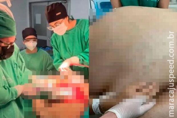 Mulher de apenas 1,5m retira tumor de 46kg no RJ Mulher de apenas 1,5m retira tumor de 46kg no RJ