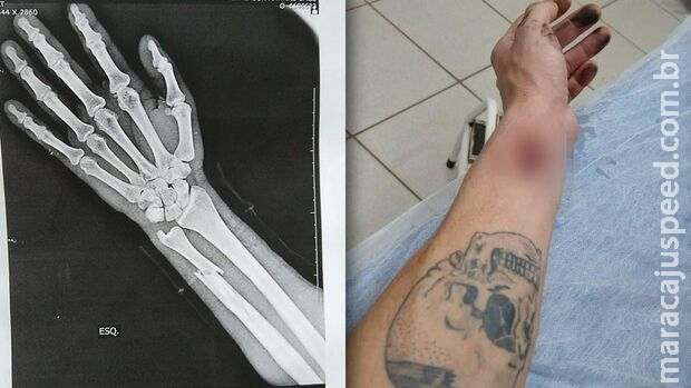 Sem realizar raio-x em UPA, paciente volta para casa com pontos em braço quebrado