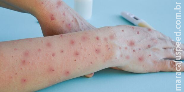 Jovem de 17 anos é diagnosticado com vírus Monkeypox em Sidrolândia Jovem de 17 anos é diagnosticado com vírus Monkeypox em Sidrolândia