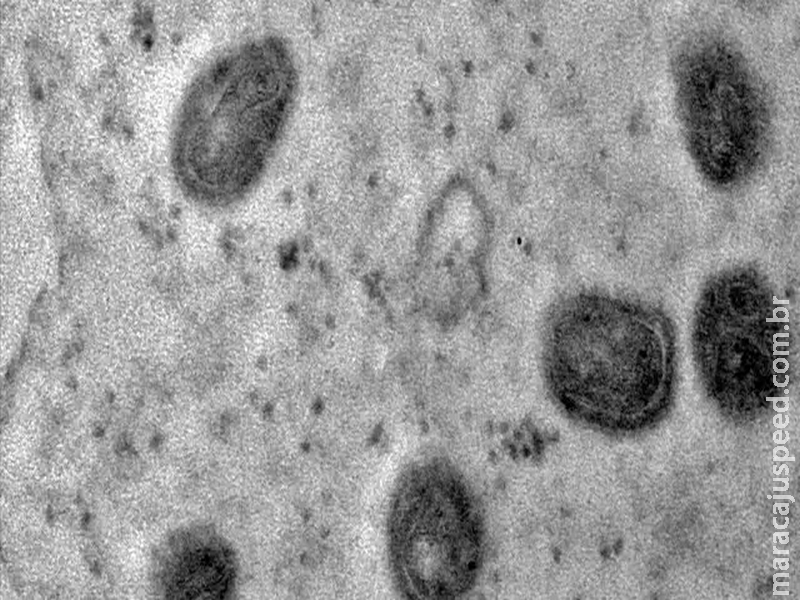 MS tem 10 pacientes com casos ativos de varíola dos macacos MS tem 10 pacientes com casos ativos de varíola dos macacos