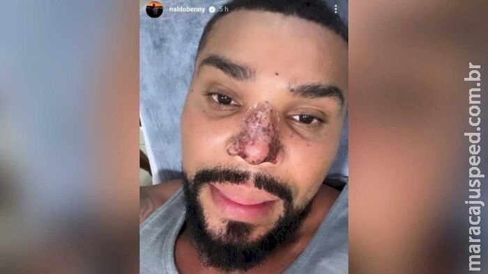 Cantor Naldo tem complicações após rinomodelação, com princípio de necrose no nariz Cantor Naldo tem complicações após rinomodelação, com princípio de necrose no nariz