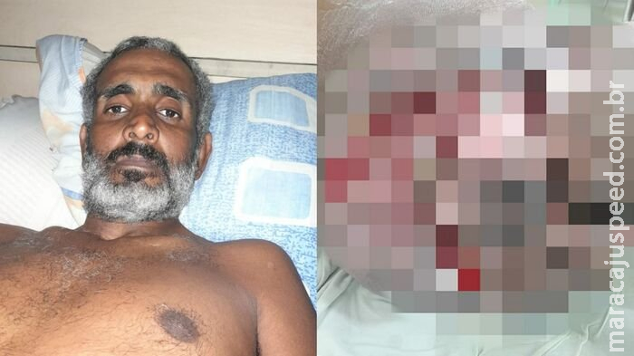 Greve faz cadeirante sofrer com ferida em carne viva no Jardim Itália: Greve faz cadeirante sofrer com ferida em carne viva no Jardim Itália: