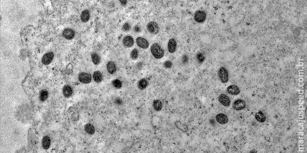 Pesquisa indica risco de monkeypox agravar infeccão por HIV Pesquisa indica risco de monkeypox agravar infeccão por HIV