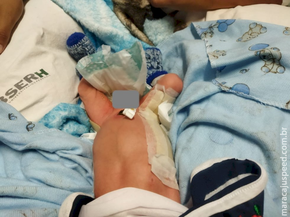 Recém-nascido sofre queimaduras em incubadora e é levado à Capital