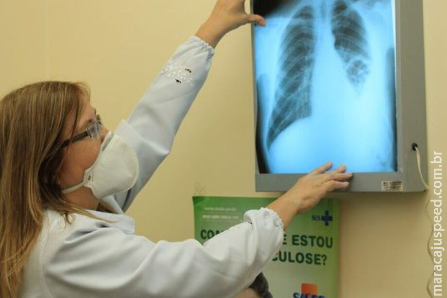 Conselho aprova novas diretrizes para tratamento da tuberculose no SUS Conselho aprova novas diretrizes para tratamento da tuberculose no SUS