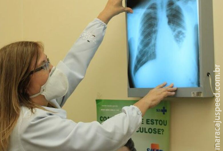 Governo cria comitê para eliminar a tuberculose Governo cria comitê para eliminar a tuberculose