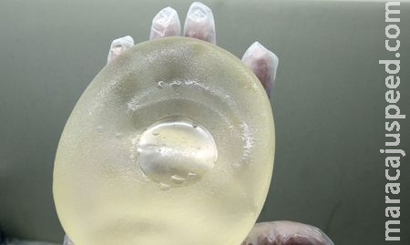 Lei garante troca de implante mamário para paciente de câncer