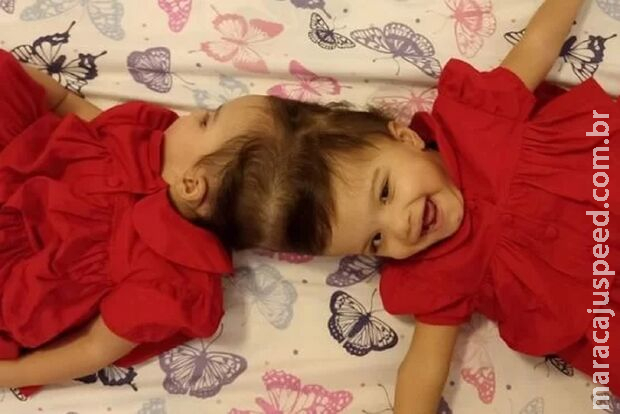 Gêmeas siamesas são separadas após cirurgia de 25 horas em SP