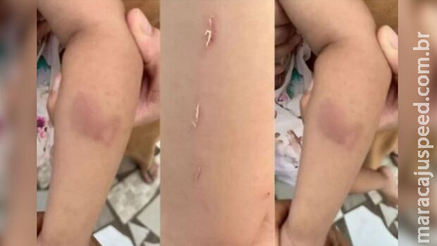 Mãe denuncia creche após filha voltar para casa com mordidas nas pernas