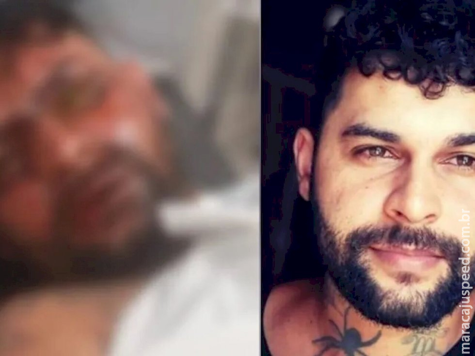 Tatuador que ficou cego com ácido perde olho após transplante 