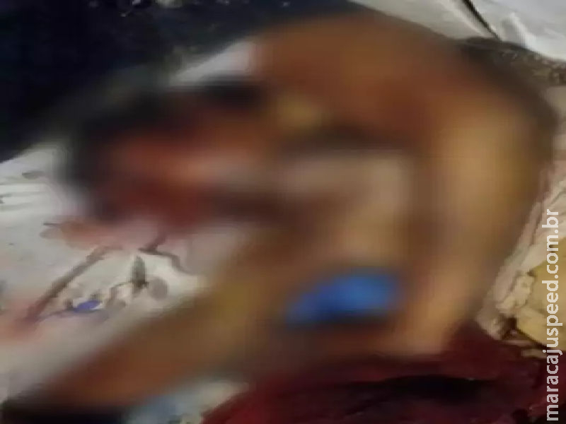Mulher que teve o rosto desfigurado em ataque de ex perdeu olho Mulher que teve o rosto desfigurado em ataque de ex perdeu olho