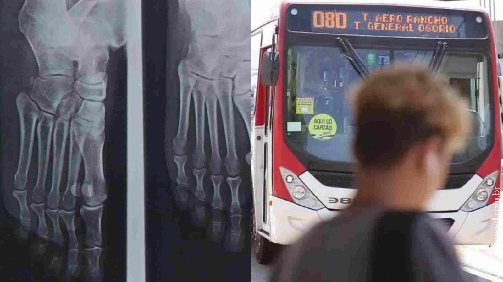 Consórcio Guaicurus é condenado a indenizar mulher que quebrou o dedo do pé em ônibus