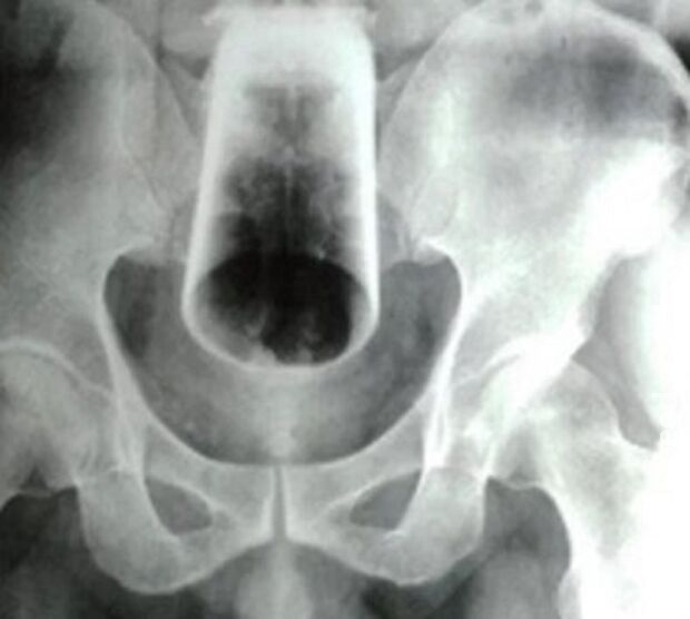 Homem enfia copo de vidro no ânus e é internado às pressas no Mato Grosso