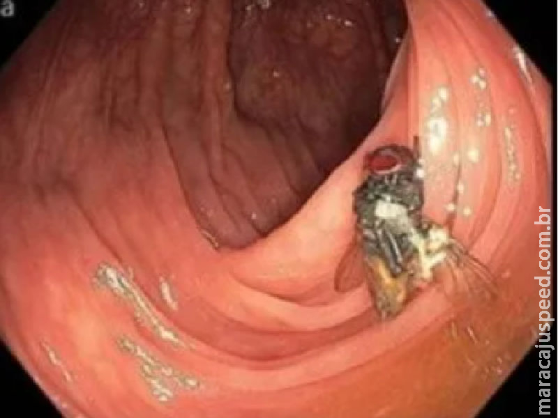 Médicos encontram mosca viva em exame de intestino de paciente