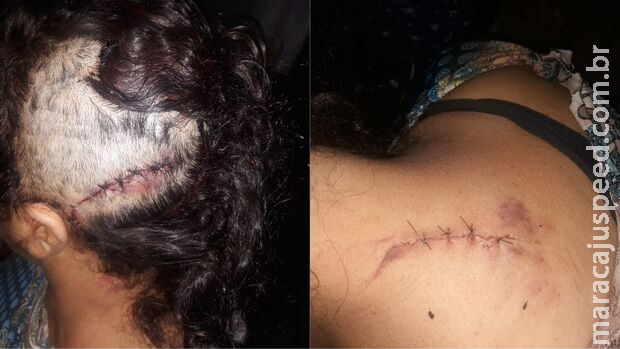 Sobrevivente: mulher atingida por foice precisa de ajuda em Campo Grande