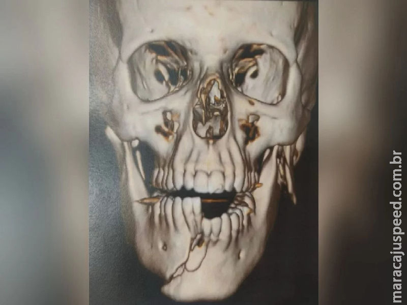 Suspeito de agredir esposa tem rosto deformado por justiceiros