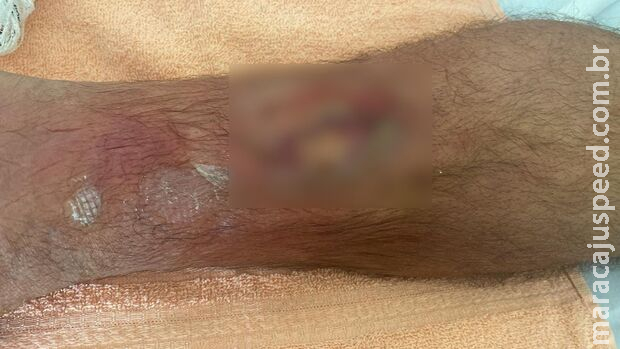 Com infecção no sangue, diabético acidentado precisa de vaga em hospital de Campo Grande