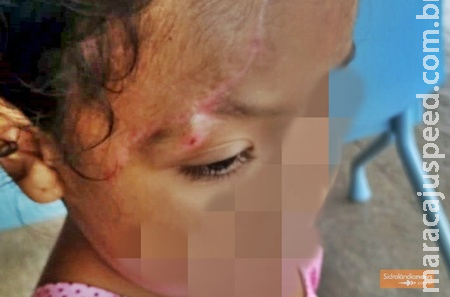 SEQUELAS APÓS INCÊNDIO. Após 15 dias em coma criança de 3 anos sofre com as sequelas dos hematomas cerebrais e queimaduras SEQUELAS APÓS INCÊNDIO. Após 15 dias em coma criança de 3 anos sofre com as sequelas dos hematomas cerebrais e queimaduras