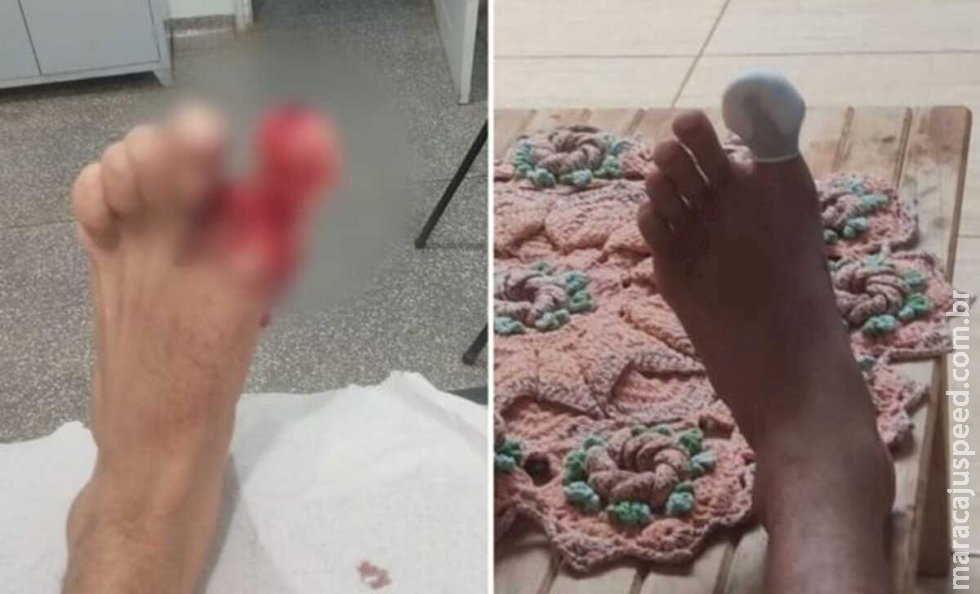  Sul-mato-grossense é mordido no pé por peixe em balneário no interior de São Paulo