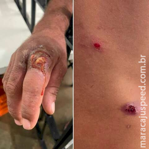 Após surto de sarna, Saúde encabeça ações de manejo, limpeza e troca de colchões