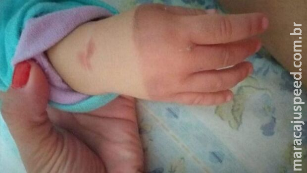 Mãe de bebê queimada pela babá deixou a enfermagem e trabalha em casa para cuidar da filha