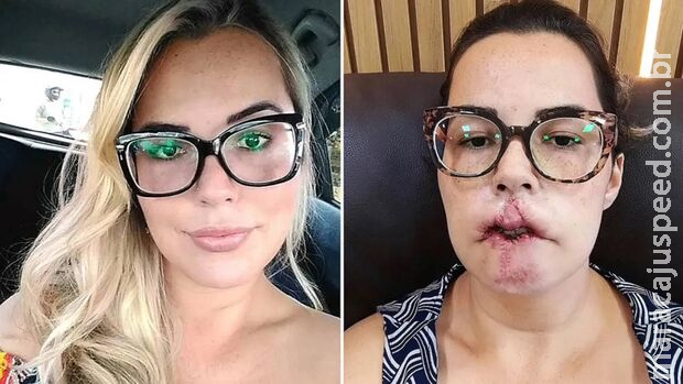 Mulher perde lábio ao fazer preenchimento com produto não recomendado Mulher perde lábio ao fazer preenchimento com produto não recomendado