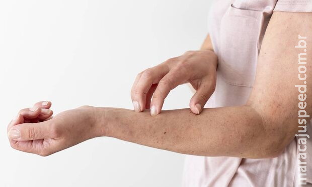 Trabalhadores de frigorífico estão com sarna em Nova Andradina