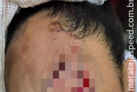 Pitbull na coleira, mas sem focinheira rasga rosto de babá no Distrito Federal Pitbull na coleira, mas sem focinheira rasga rosto de babá no Distrito Federal