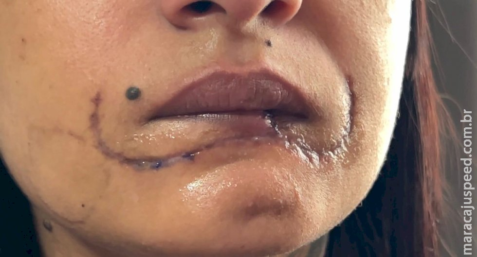 Polícia investiga caso de mulher que perdeu metade do lábio ao ser mordida pelo ex no interior de SP; suspeito fugiu